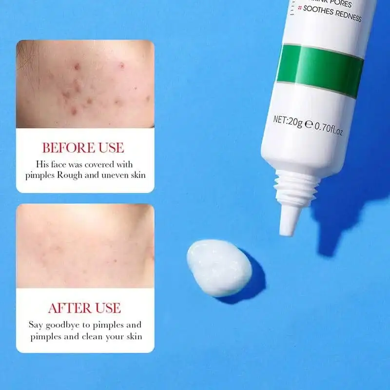 Close-up of Bioaqua Salicylic Acid Acne Removal Cream being squeezed onto a finger. - thumbnail