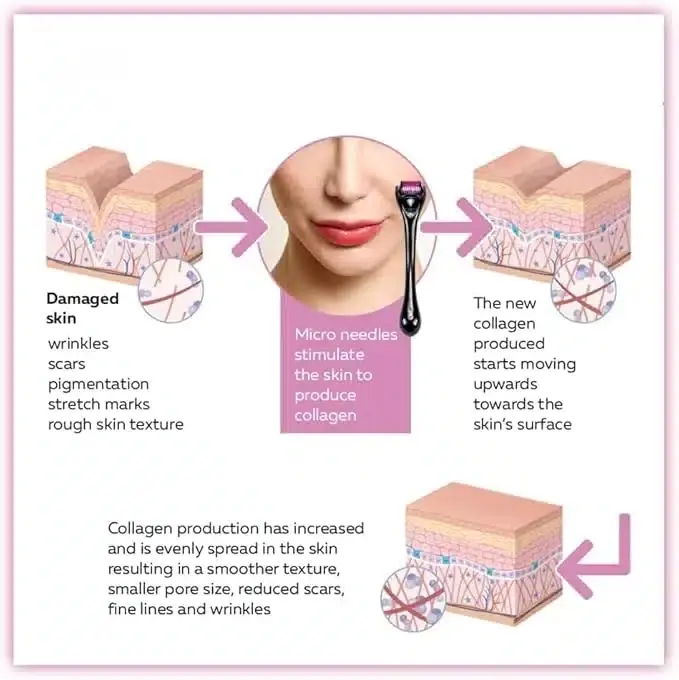 Derma Roller device held in hand, showing ergonomic white handle and black 540 needle head. - thumbnail